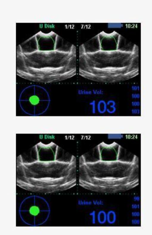 Bladder Scanner BVT02