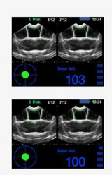 Bladder Scanner BVT02