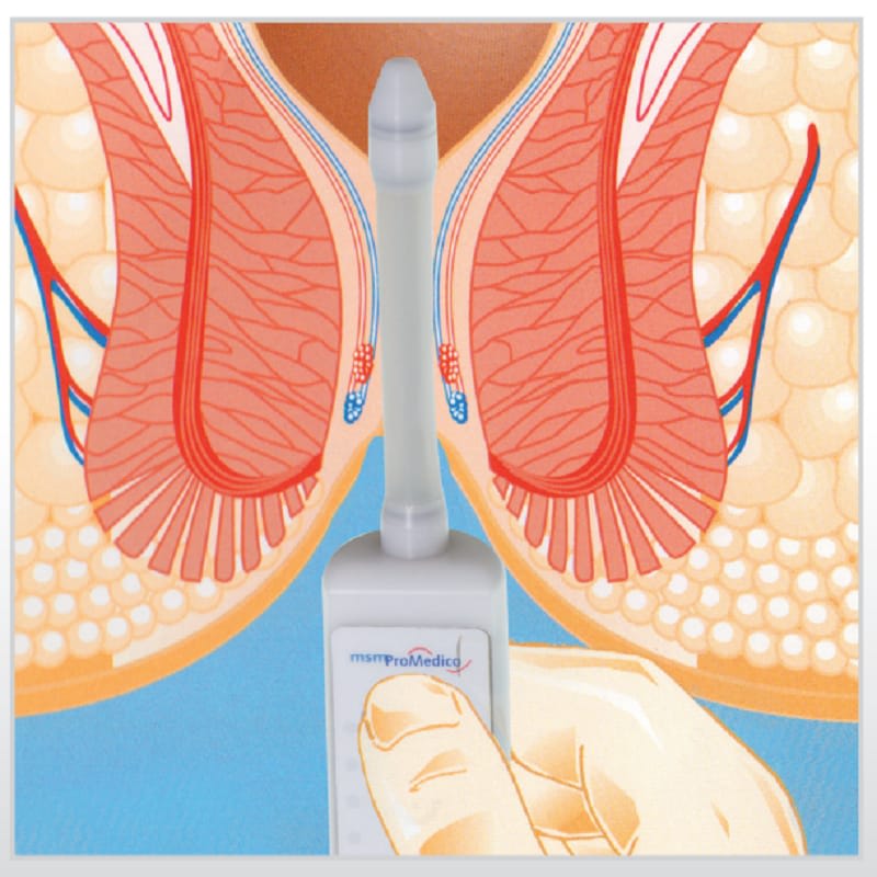 Portable Sphinctometer - Anal & Vaginal Tonometry