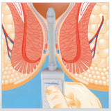 Portable Sphinctometer - Anal & Vaginal Tonometry